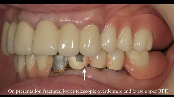 Newsletter 76: Jackie’s case – Telescopic overdenture & precision RPD (the tricky truth!)