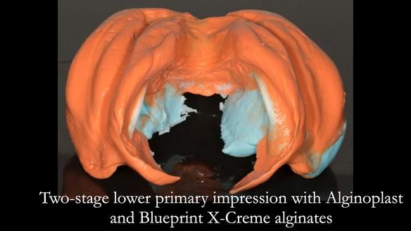 Newsletter 75: Marion’s case - Step-by-step complete denture workflow