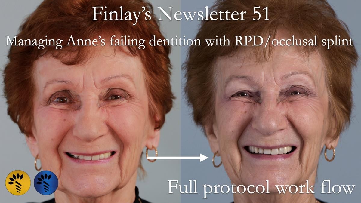 Full protocol to provide a metal based removable partial denture/occlusal stabilisation splint to resolve missing teeth and TMJ pain.