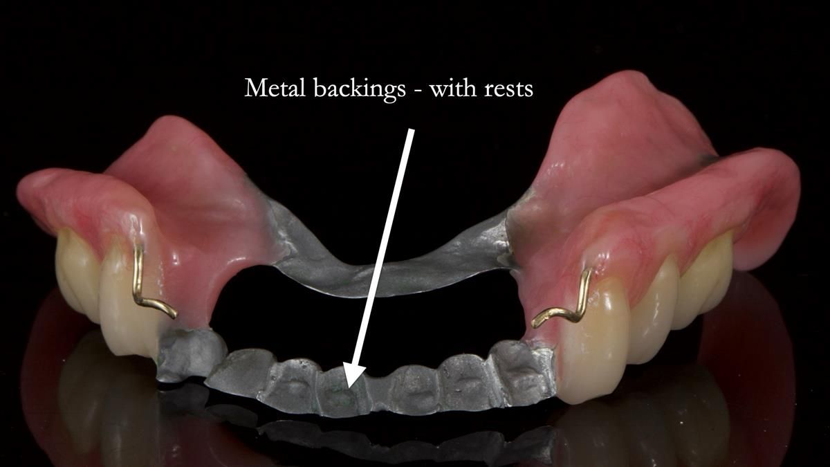 Newsletter 87 – Father Peter: A Partial Denture that needed Minor Miracle