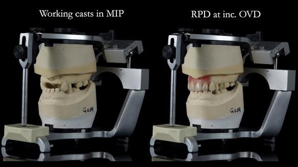 Newsletter 81 - Pam’s Story — how a partial denture changed her life (+ live walkthrough this Thursday)