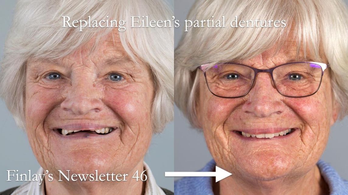 Eileen's transformation with upper and lower RPDs of Scandinavian hygienic design FULL PROTOCOL