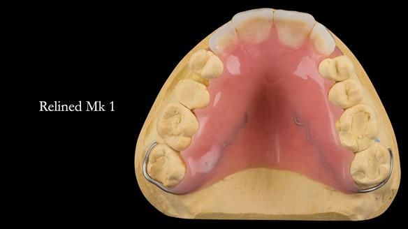Finlay's Newsletter 63 Case study provision of metal based Scandinavian RPD - functional 10 years on