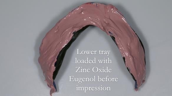 Newsletter 80 - Gordon’s dentures: the one case in 1,000 where my technique failed