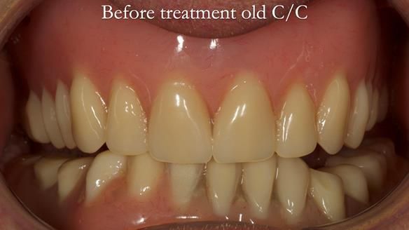 Complete denture Class II div 2 deep overbite Newsletter 39