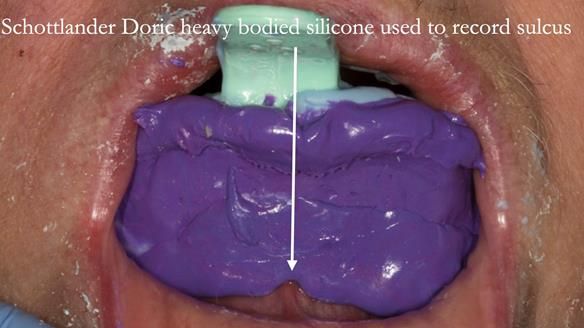 Finlay's Case Study Newsletter 40 - Immediate Mk 1 RPD to Definitive Mk 2 RPD - full protocol