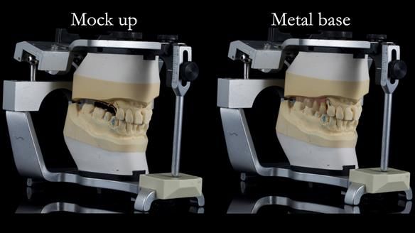 Newsletter 56 showing the making and fitting of a bilateral free end saddle upper removable partial denture (RPD) for patient with pemphigus
