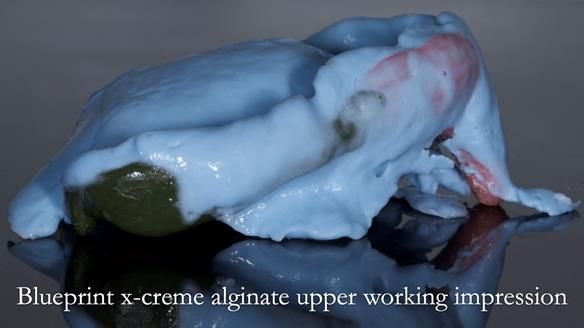 Newsletter 54 case presentation upper complete denture and lower Scandinavian designed hygienic partial denture for David