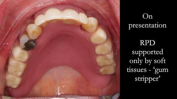 Finlay's Newsletter 59 Ultra hard partial dentures made for Gill