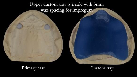 Newsletter 57 showcases the making and fitting process of implant-supported complete dentures for Alisdair