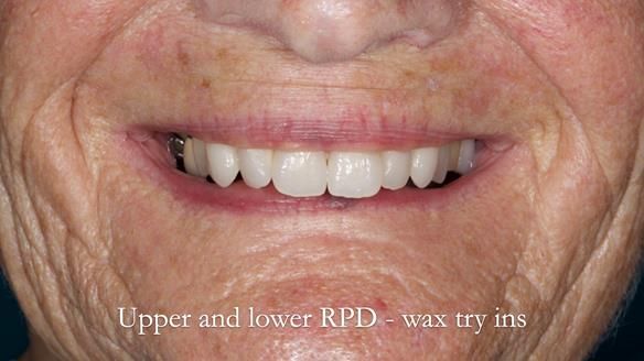 Eileen's transformation with upper and lower RPDs of Scandinavian hygienic design FULL PROTOCOL