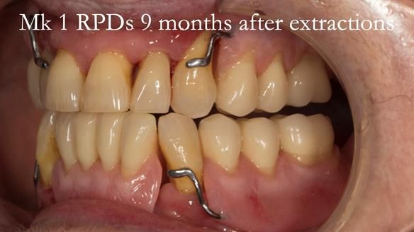 Finlay's Case Study Newsletter 40 - Immediate Mk 1 RPD to Definitive Mk 2 RPD - full protocol