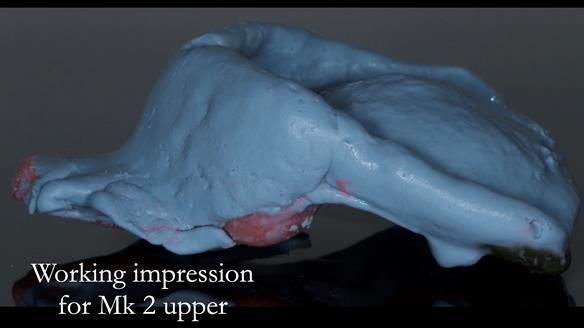 Finlay's Case Study Newsletter 40 - Immediate Mk 1 RPD to Definitive Mk 2 RPD - full protocol