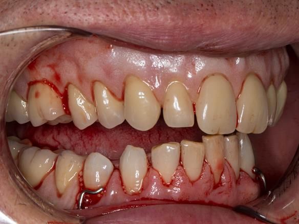Figure 45 Visit 2 fitting of Mk 1 upper complete and lower partial immediate dentures