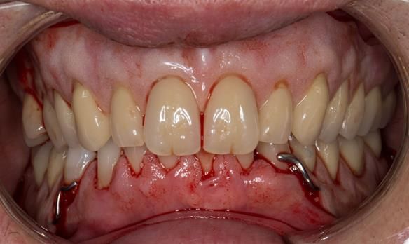 Figure 44 Visit 2 fitting of Mk 1 upper complete and lower partial immediate dentures