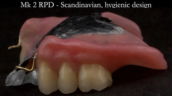 Finlay's Case Study Newsletter 40 - Immediate Mk 1 RPD to Definitive Mk 2 RPD - full protocol