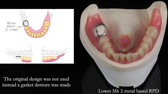 Newsletter 82 Mary - A complete upper and a one-tooth gasket denture