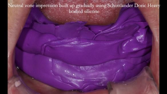 Newsletter 83: Sheila’s Complete Denture Success