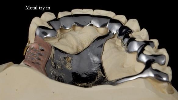 Finlay's Newsletter 64 case study - provision of a Kennedy class 2 metal based Scandinavian RPD for Ian