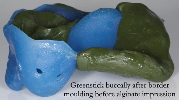 Newsletter 55 Provision of metal based partial dentures for Zephyrine with a repaired cleft lip and palate