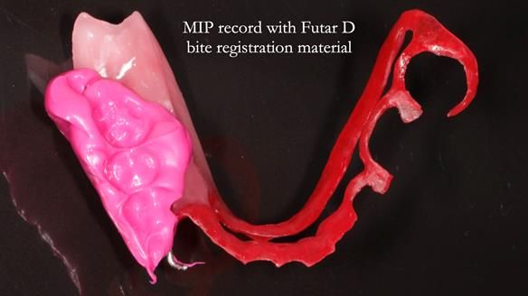 Finlay's Newsletter 61 provision of a lower unilateral free end saddle metal based partial denture for Joyce