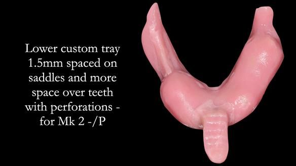 Newsletter 54 case presentation upper complete denture and lower Scandinavian designed hygienic partial denture for David