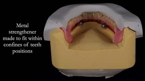 Newsletter 57 showcases the making and fitting process of implant-supported complete dentures for Alisdair