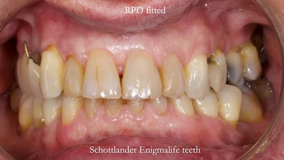Finlay's Newsletter 64 case study - provision of a Kennedy class 2 metal based Scandinavian RPD for Ian