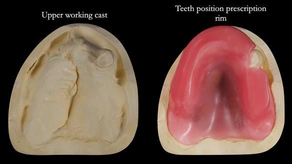 Newsletter 55 Provision of metal based partial dentures for Zephyrine with a repaired cleft lip and palate