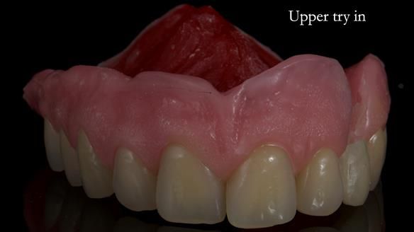 Newsletter 55 Provision of metal based partial dentures for Zephyrine with a repaired cleft lip and palate