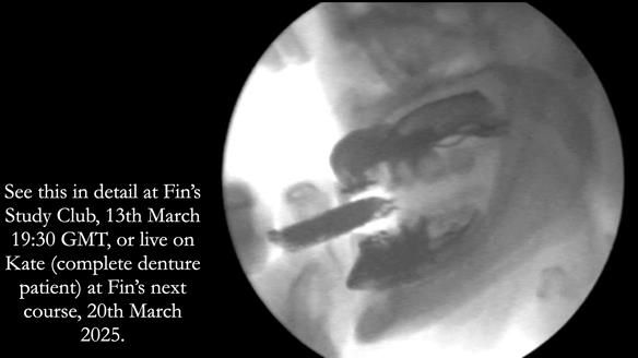 Newsletter 75: Marion’s case - Step-by-step complete denture workflow