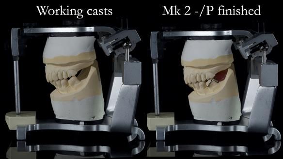 Newsletter 54 case presentation upper complete denture and lower Scandinavian designed hygienic partial denture for David