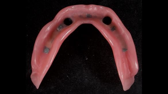 Newsletter 57 showcases the making and fitting process of implant-supported complete dentures for Alisdair