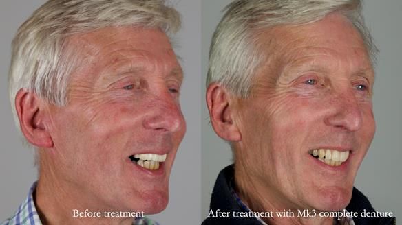 Newsletter 77: Jeremy’s case – immediate complete upper denture
