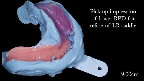 Newsletter 52 Managing Jo’s failing dentition with extractions and Mk 1/Mk 2 complete upper dentures and lower partial dentures FULL PROTOCOL