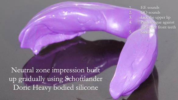 Replacing Madeline’s Complete denture FULL PROTOCOL