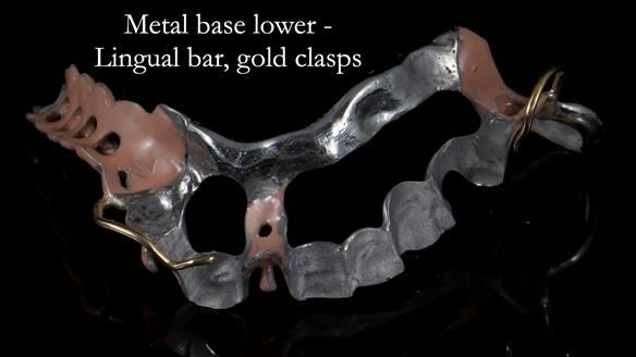 Newsletter 55 Provision of metal based partial dentures for Zephyrine with a repaired cleft lip and palate