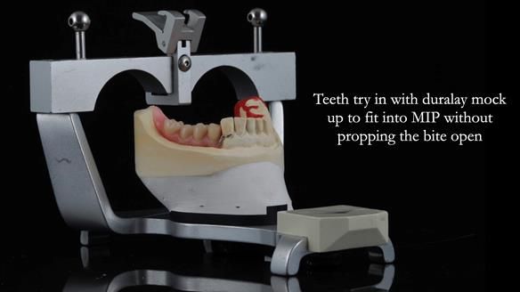 Finlay's Newsletter 61 provision of a lower unilateral free end saddle metal based partial denture for Joyce