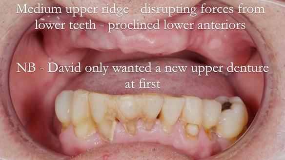 Newsletter 54 case presentation upper complete denture and lower Scandinavian designed hygienic partial denture for David