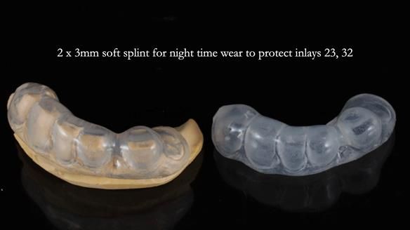 Newsletter 55 Provision of metal based partial dentures for Zephyrine with a repaired cleft lip and palate