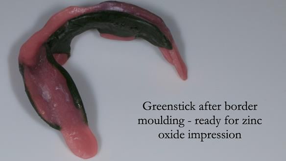 Complete denture Class II div 2 deep overbite Newsletter 39