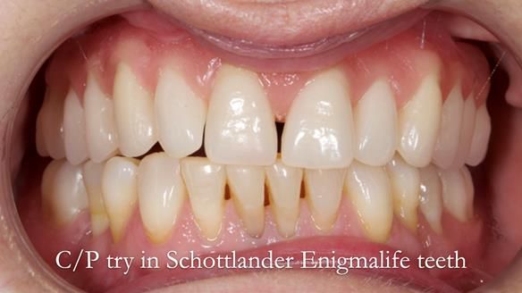 Solving Linda’s Failed “All on 4” implant bridges - full protocol Newsletter 42