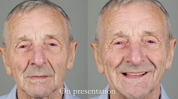 Newsletter 80 - Gordon’s dentures: the one case in 1,000 where my technique failed