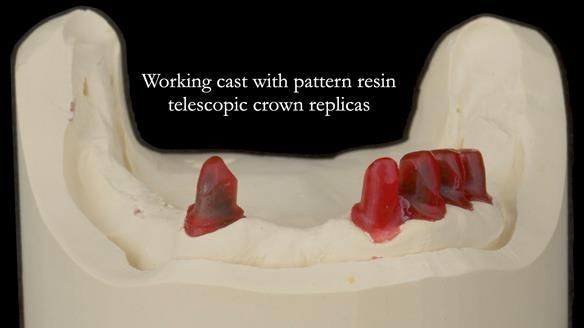 Newsletter 76: Jackie’s case – Telescopic overdenture & precision RPD (the tricky truth!)