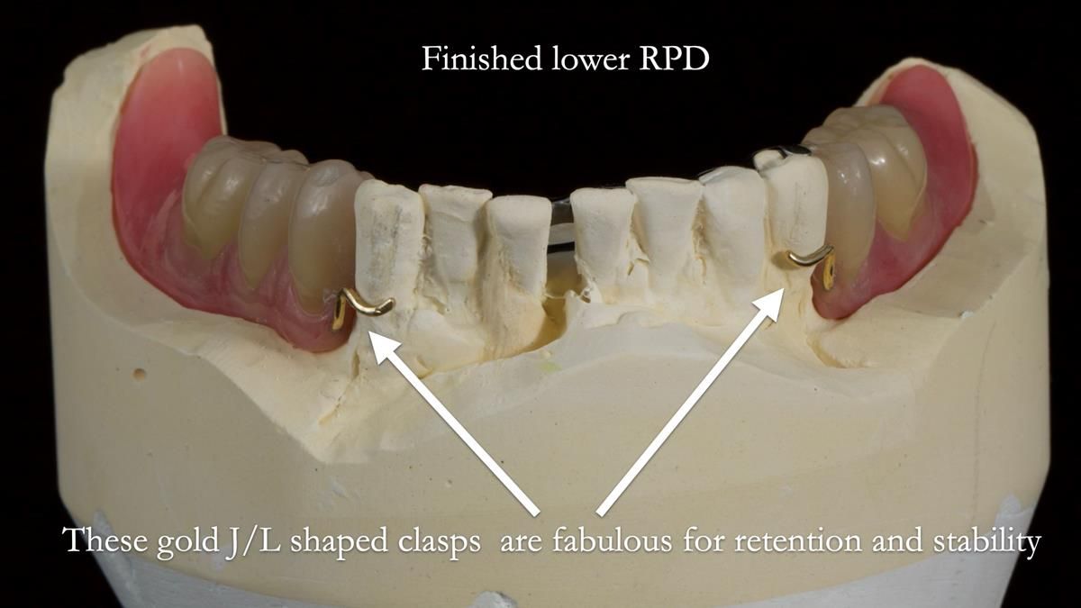 Newsletter 87 – Father Peter: A Partial Denture that needed Minor Miracle