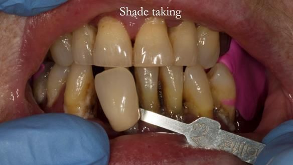 Finlay's Case Study Newsletter 40 - Immediate Mk 1 RPD to Definitive Mk 2 RPD - full protocol