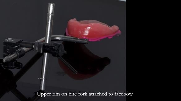 Newsletter 83: Sheila’s Complete Denture Success