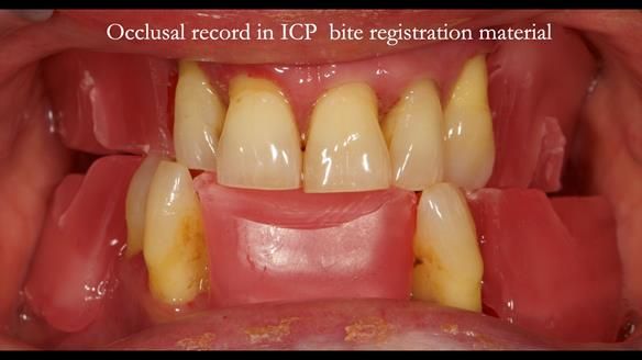 Finlay's Case Study Newsletter 40 - Immediate Mk 1 RPD to Definitive Mk 2 RPD - full protocol