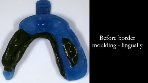 Finlay's Newsletter 61 provision of a lower unilateral free end saddle metal based partial denture for Joyce