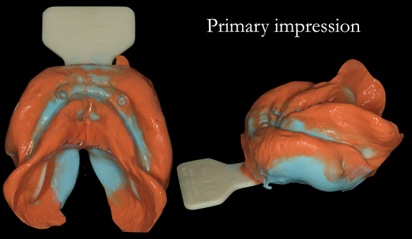 Figure 13 Lower primary impression with two viscosities using Zhermack Tropcalgin (base) and Neocolloid (Syringe). This allows full extension to record the sulcui